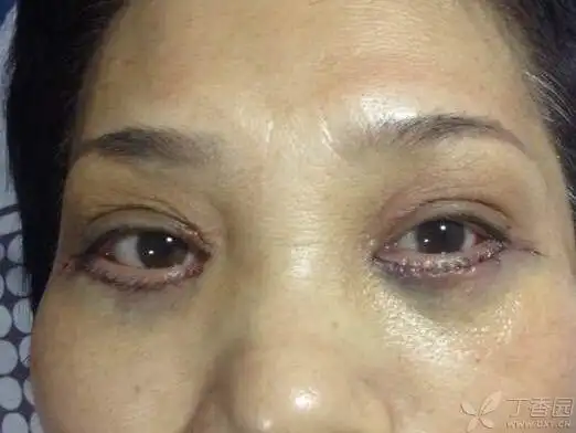 【讨论】眼袋术后十天一侧外翻