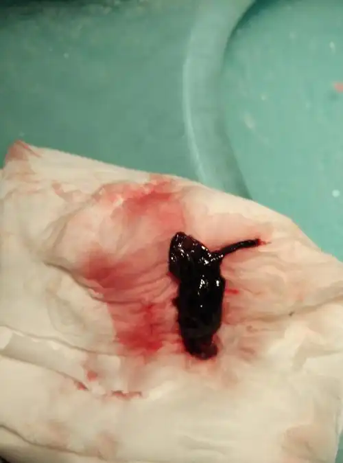 怀孕一个月就有出血,医生却说不需要处理