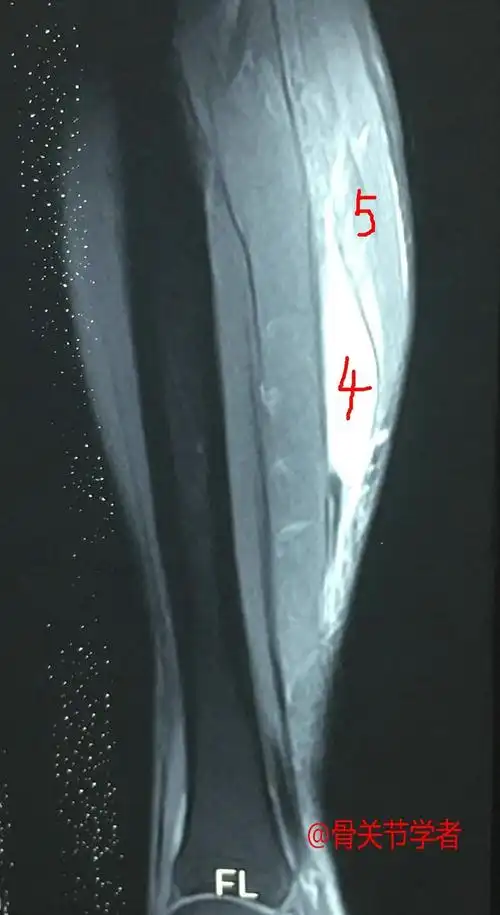 4是血肿  5是内侧腓肠肌