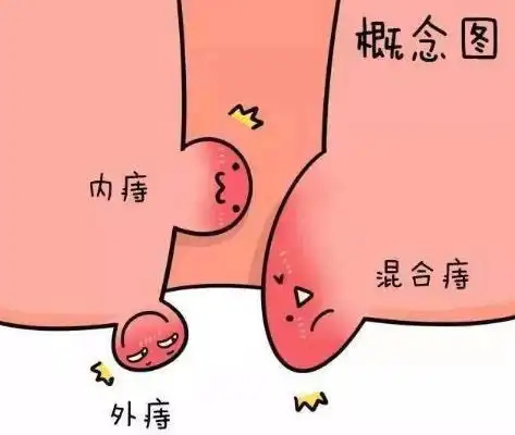 混合痔:在临床兼有内痔和外痔的症状.