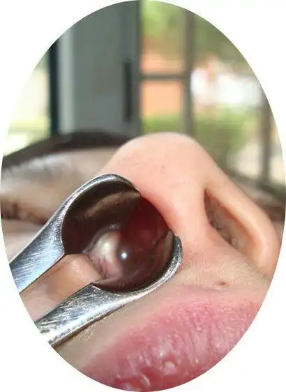 鼻息肉对我们的危害性