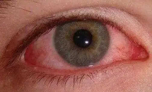 但由于结膜炎多为接触感染,因此勤洗手,洗脸,不用手和衣物揉擦眼睛