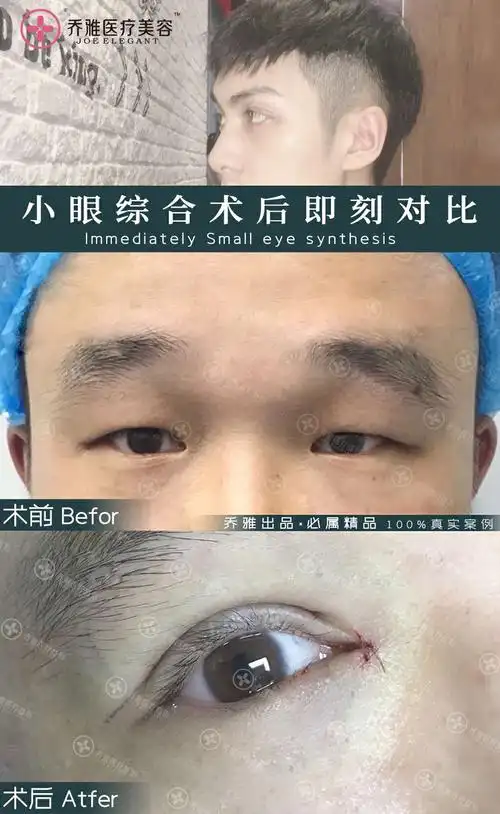 男士开眼角手术效果图