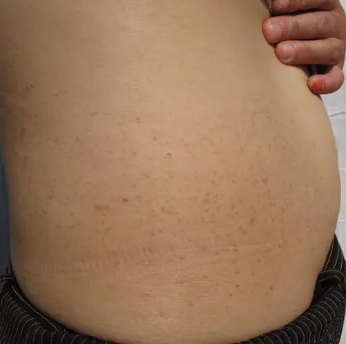 腰部多年的斑点