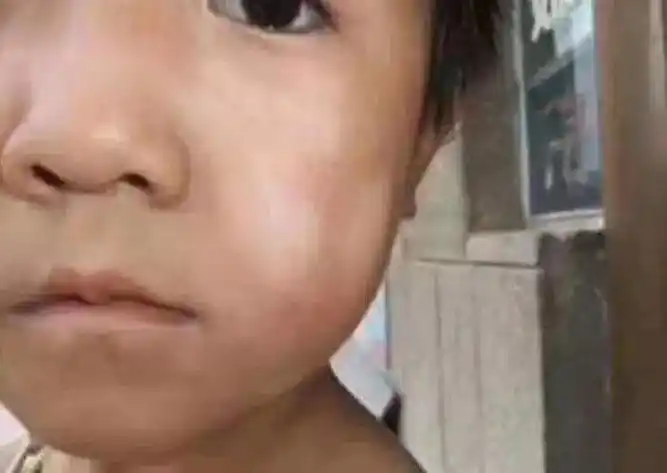 娃娃脸上一块白,一块白的,是蛔虫斑吗71 - 抖音