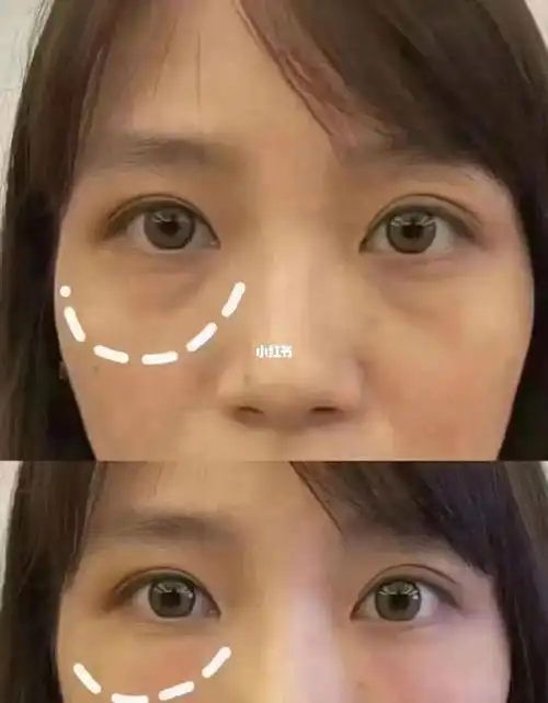 泪沟填充前后对比