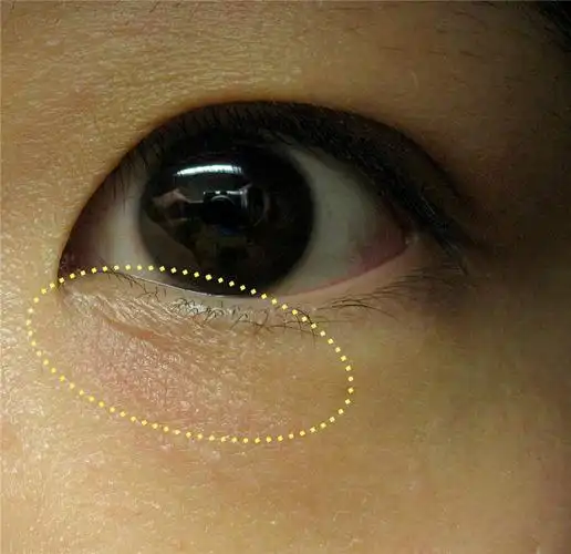 淡化细纹,改善肤质,拒绝衰老_ultraking超声刀