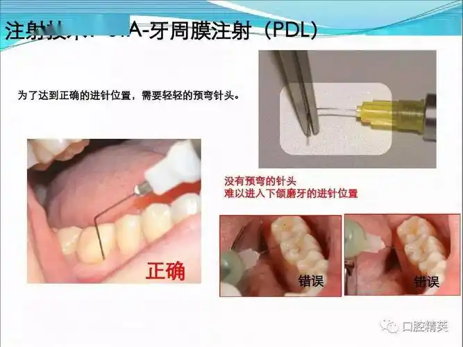 如何实现安全舒适口腔麻醉