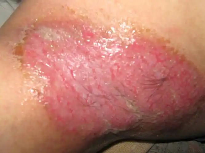 皮肤及性传播疾病讨论版 - 爱爱医医学论坛