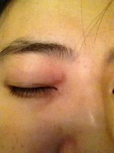 一年了,一直长在我的右眼周围皮肤下眼角也会长.