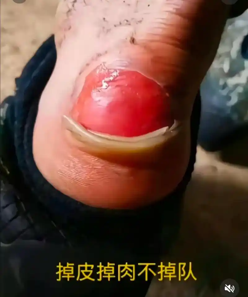 q 看着就心疼 他们的背因暴晒而脱皮 肉 庞个个都是父母的心 - 抖音