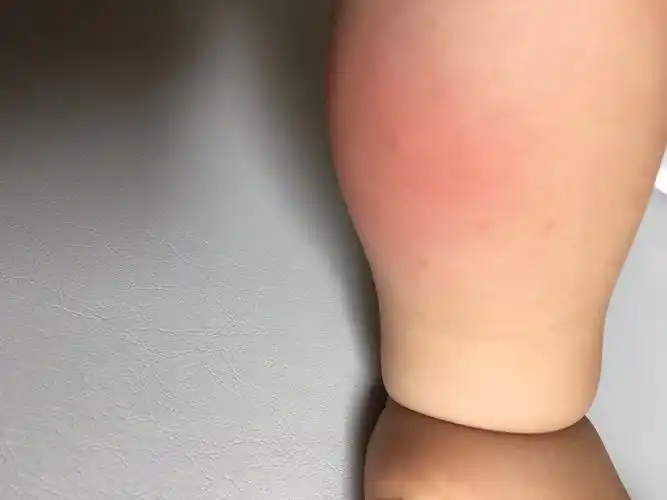 病情描述:蚊虫叮咬致红肿咨询