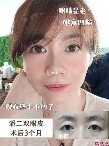 眼窝凹陷怎么办71全切双眼皮后年轻又温婉