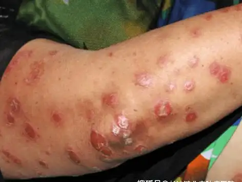 好口碑长沙银屑病医院:银屑病是什么原因引起的?会传染吗!