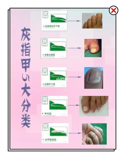 灰指甲分类与对比1529o2916