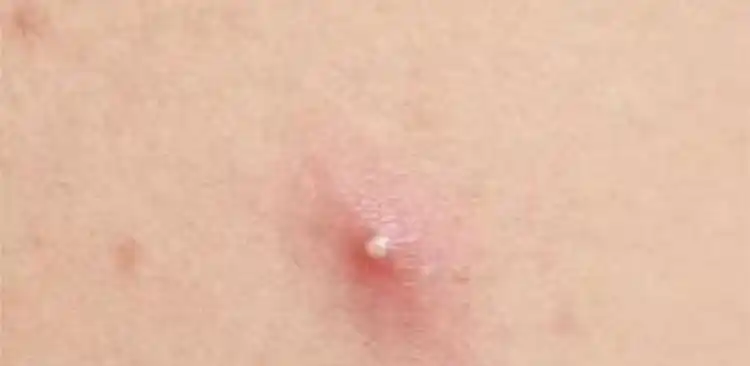 疥疮的治疗方法疥疮结节阴囊怎么治