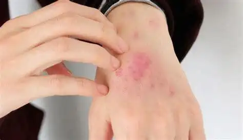 得了梅毒身上会痒吗得了梅毒有什么症状2022已更新今日推荐