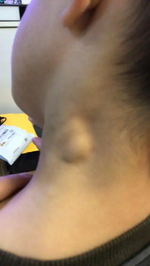 孩子脖子俩侧有疙瘩谁知道什么情况啊