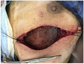 年轻男子隆起的酥胸为哪般成功切除胸壁巨大肿瘤