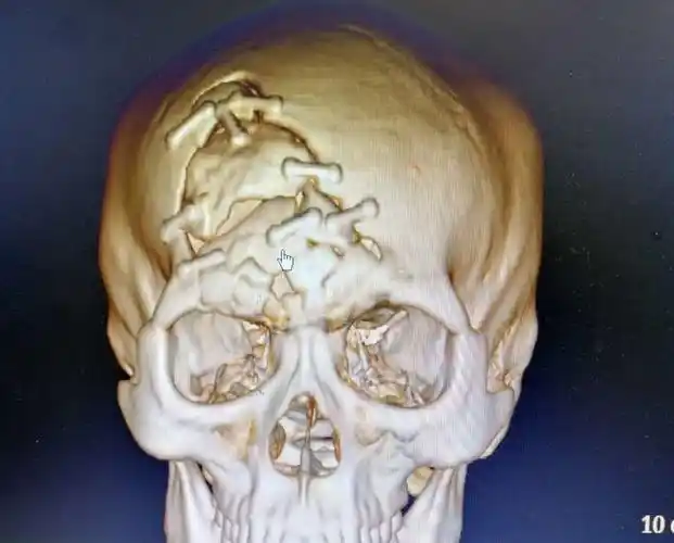 开放性粉碎性凹陷性骨折治疗一例