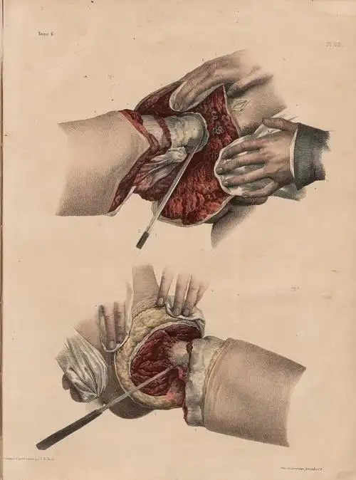 换头术或本世纪最恐怖手术19世纪插画中的手术更恐怖