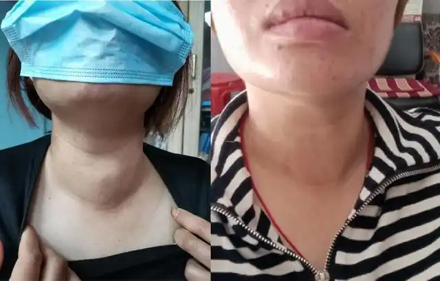 巨大甲状腺结节也可以做微波消融梧州红会医院做到了