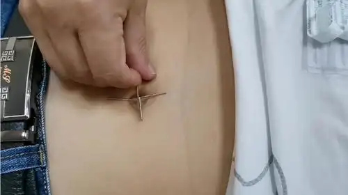 脐针减肥三针视频在线观看 - 西瓜视频