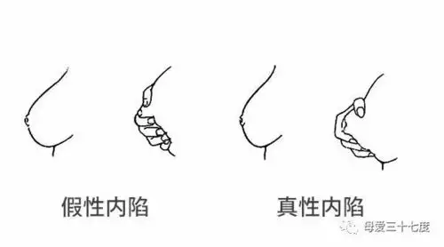 乳头凹陷还能喂奶吗?