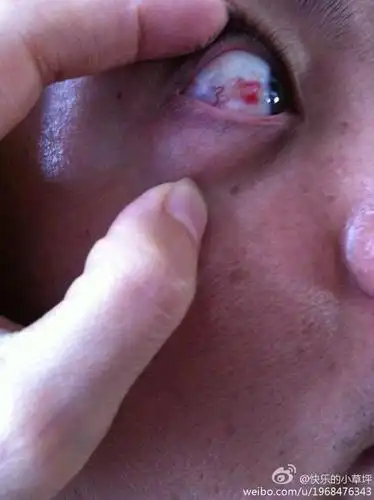 今天下午我先生眼睛里突然多了一块红斑请问是什么原因?需怎?