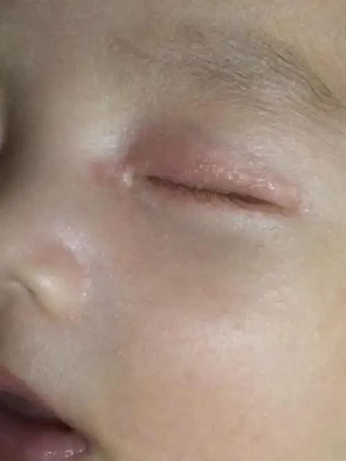 宝宝左眼有点红,右眼有一点点这是怎么回事?