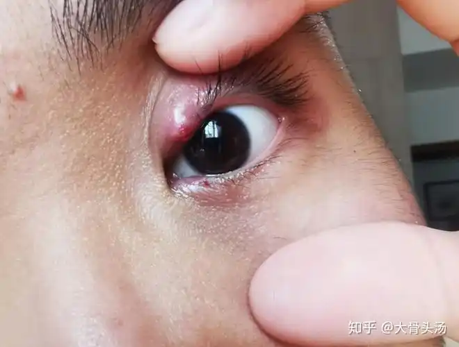 麦粒肿怎么较快恢复是外麦粒肿刚长起来