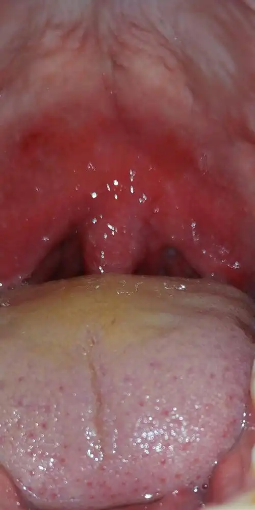 问:急性咽炎,怎么治疗,悬雍垂水肿