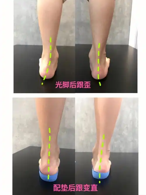 足弓鞋垫对于扁平足,后跟不直,外八的作用