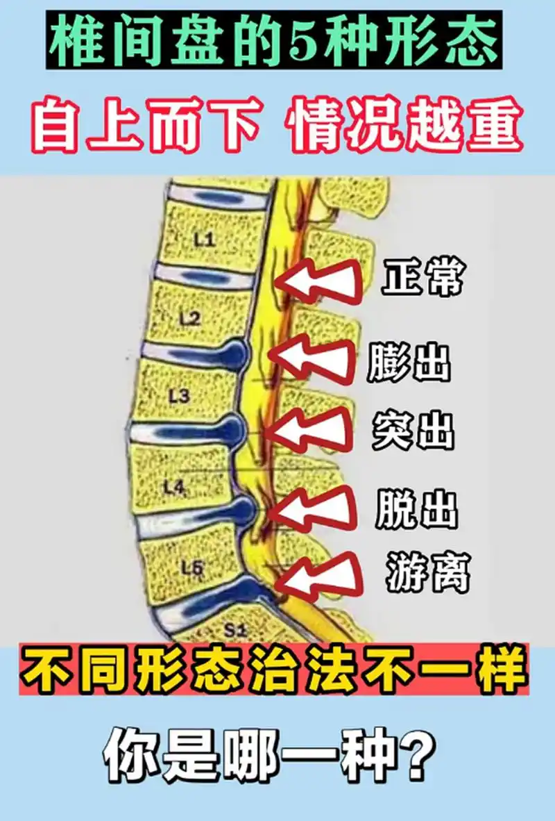 自上而下 情况越重  l1:正常 l2:膨出 l3:突出 l4:脱出 l5:游离 不同