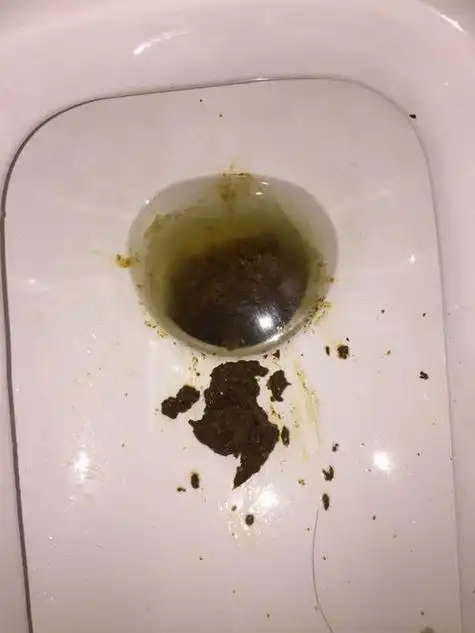 大便的颜色,性状和次数和疾病密切相关:拉黑便可能是胃出血,拉血便