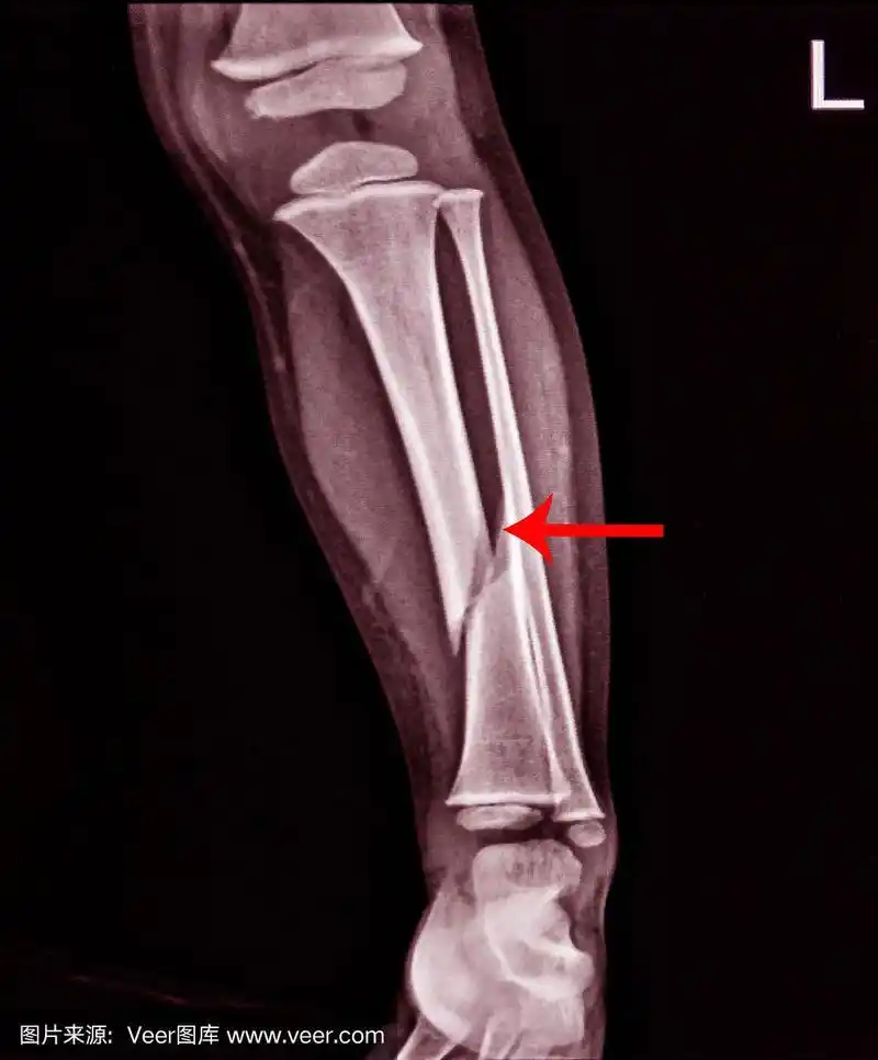 左腿ap外侧骨折x线片.