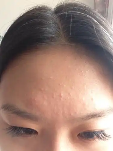 我的脸上长了好的小疙瘩啊 有时候还有点痒 怎么办啊