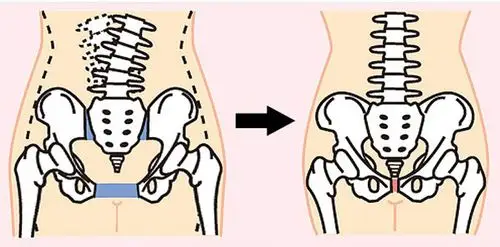 苏州骨盆矫正日式骨盆矫正术