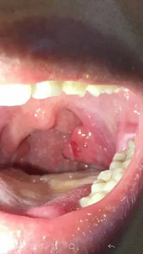 需要切除吗,需要多少钱,.局麻还是全麻?疼不疼.危险吗.