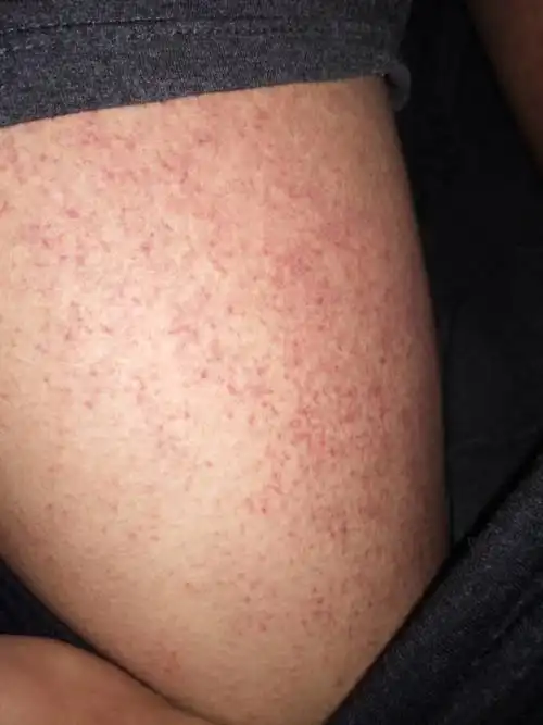 大腿上好多红点点怎么回事会不会是性病