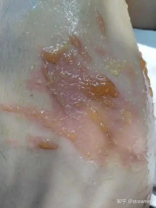 记录烫伤的恢复过程