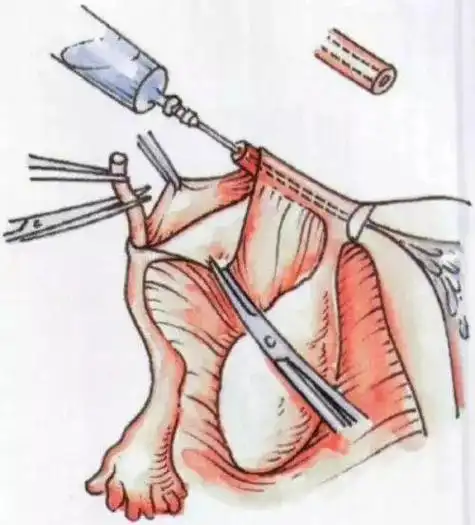 达到避孕的目的,女性结扎手术后,如果要求再次生育,可以进行输卵管