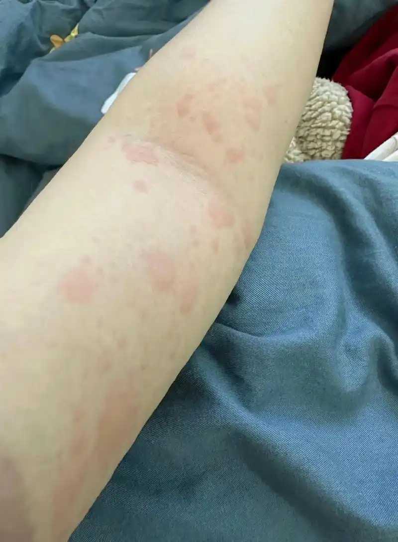 小阳人第二天开始出现皮肤过敏,刚开始是打预防针的地方有的痒, - 抖