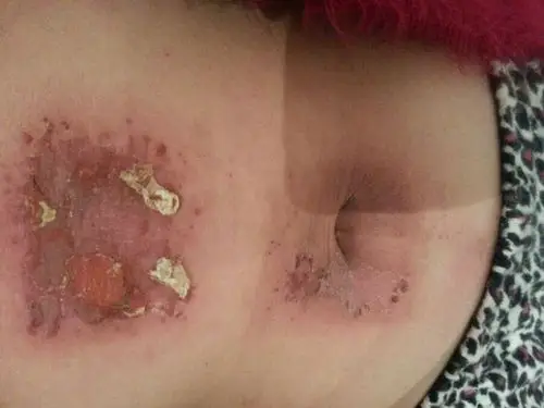 艾灸被烫成这样 说是灸花你信吗?