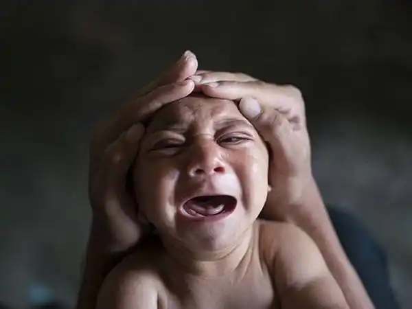 小头症患儿.(图片来源:英国《每日邮报》)