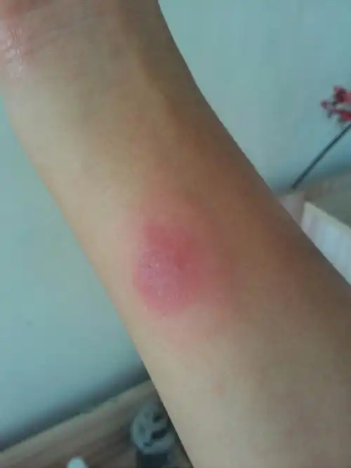 昨天做了肺结核皮试今天是第一天他说2天后看情况第一天是这样有