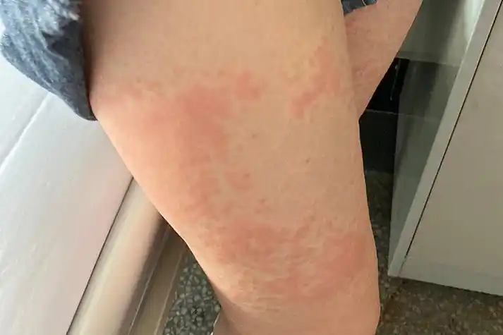 过敏性皮炎图片和症状