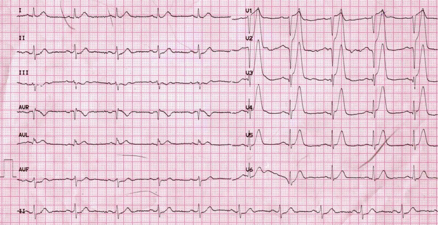 猝死预警心电图分析经典病例