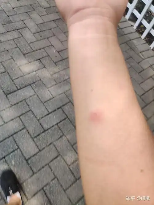 结核ppd皮试,这样正常吗! - 知乎