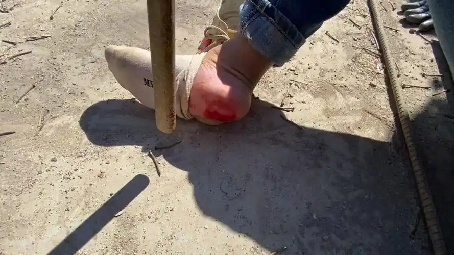 兄弟你们被钉子扎到脚会这样处理吗